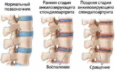 БОЛЕЗНЬ БЕХТЕРЕВА https://m.vk.com/@med_sport-bolezn-behtereva3 Article