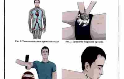 Памятка по временной остановке наружного кровотечения ● При артериальных кровотечениях: из ран головы, шеи,…