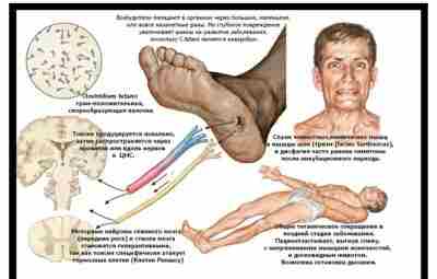 СТОЛБНЯК (TETANUS) Столбняк – острое инфекционное заболевание, обусловленное воздействием на организм экзотоксина столбнячной палочки…