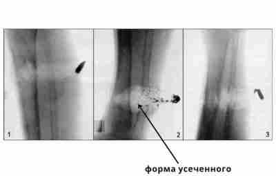 Раневая баллистика Раневой канал — это путь, который проходит пуля в теле. Начинается входным…