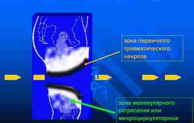 Зоны повреждения при огнестрельном ранении: 1-я зона-раневой канал. Он содержит пулю и иные инородные…