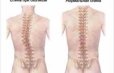 Сколиоз появляется из-за ношения сумки на одном плече или из-за неправильного сидения за партой?…