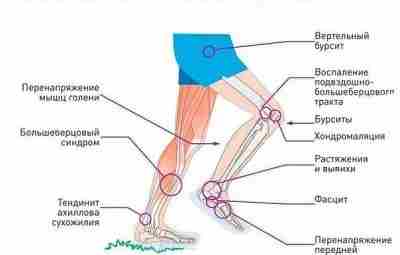 Беговые боли, травмы и их лечение. Травмы голени Травмы голени очень болезненны и долго…