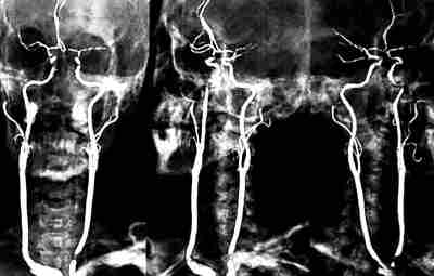 Рентген с контрастированием сонных артерий. Выглядит жутковато только для непосвященных: