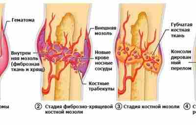 Типы сращения переломов кости Существуют различные типы сращения переломов кости. В общем случае используются…