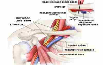 СИНДРОМ ГРУДНОГО ВЫХОДА (Thoracic Outlet syndrome) Боли в верхней конечности и плечевом поясе могут…