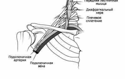 Синдром грудного выхода Peet и др. в 1956 году использовали термин синдром грудного выхода…