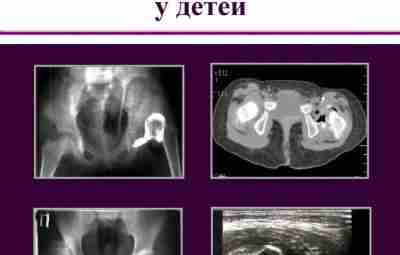 Врожденный вывих бедра у детей Книга подразумевает рассмотрение проблемной патологии у детей — врожденного…