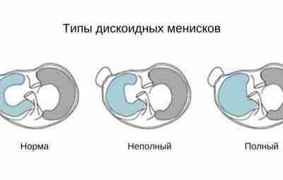 Дискоидный мениск Дискоидный (буквально: мениск похожий на диск) мениск является разновидностью обычного мениска. Патология…