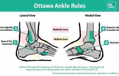 Ottawa Ankle Rules Оттавские правила голеностопа определяют необходимость выполнения рентгенограмм при острых травмах сустава….