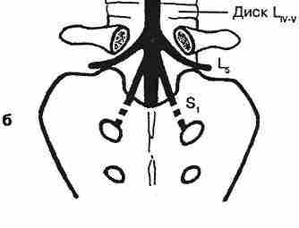 Компрессия корешка S1 Этот корешок фиксирован к дуральному мешку на уровне межпозвонкового диска L5-S1….