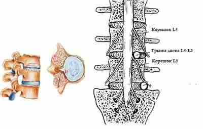 Компрессия корешка L5 Этот корешок фиксирован к дуральному мешку на уровне межпозвонкового промежутка L4-5….