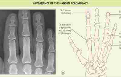 Артропатии, ассоциированные с эндокринной патологией. Акромегалия. Акромегалия — это тяжелое нейроэндокринное заболевание, обусловленное хронической…
