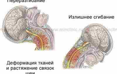 ХЛЫСТОВАЯ ТРАВМА Термин «хлыстовая травма» (ХТ) используется для описания травмы шеи вследствие ее форсированного…