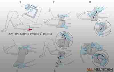 Наложение бандажа при травматической ампутации 1. Извлеките бандаж из упаковки и удалите ненужные пластиковые…