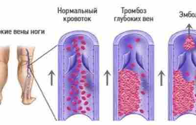 Профилактика тромбозов глубоких вен и тромбоэмболических осложнений при длительных авиаперелетах Риск тромбозов увеличивается преимущественно…