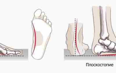 Плоскостопие Pes planus или плоская стопа, — это деформация стопы, характеризующаяся опущением ее продольного…