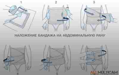 Наложение бандажа на рану на абдоминальную рану (рану живота) 1. Извлеките повязку из упаковки…