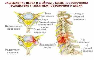 Защемление нерва Синонимы: синдром сдавления нерва, компрессионная невропатия, компримирование периферического нерва. Защемление нерва возникает,…