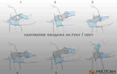 Наложение бандажа на рану на конечности 1. Извлеките повязку из упаковки и закройте рану…