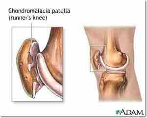 Феморопателлярный артроз («Колено бегуна») Описание «Колено бегуна» (феморо-пателлярный артроз) — состояние, при котором возрастает…