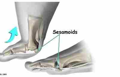 Патология сесамовидных костей стопы С подошвенной стороны плюснефалангового сустава первого пальца стопы в структуре…