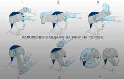 Наложение бандажа на рану головы 1. Извлеките бандаж из упаковки. Расположите впитывающую подушку непосредственно…