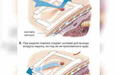 Окклюзионная повязка из подручных средств О том, чем опасны ранения грудной клетки, и что…