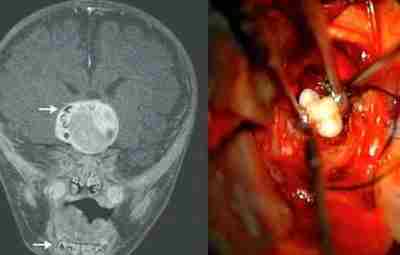 Зубы головного мозга. Врачи штата Мэриленд удалили четырехмесячному ребенку опухоль мозга, в которой обнаружили…