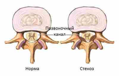 Стеноз позвоночного канала на уровне шейного отдела Стеноз (сужение) позвоночного канала на уровне шейного…