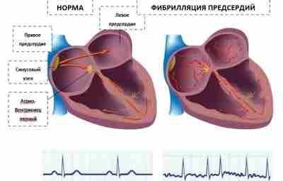 ФИБРИЛЛЯЦИЯ ПРЕДСЕРДИЙ И АЛКОГОЛЬ #кардиология #алкоголь Фибрилляция предсердий (ФП, синоним — мерцательная аритмия) нерегулярные…