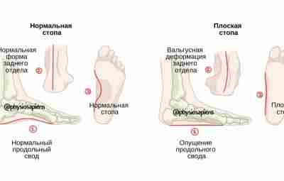 Плоскостопие Pes planus или плоская стопа, — это деформация стопы, характеризующаяся опущением ее продольного…