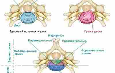ЕЩЕ РАЗ О ДИСКОГЕННЫХ ВЕРТЕБРАЛЬНЫХ НАРУШЕНИЯХ В позвоночном канале выпавший диск может быть расположен…