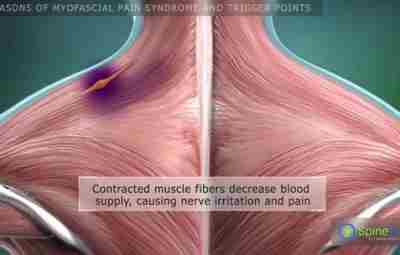 ПРОСТО И ДОСТУПНО_МИОФАСЦИАЛЬНЫЙ РЕЛИЗ И ПРИНЦИПЫ МАНУАЛЬНОГО ЛЕЧЕНИЯ МИОФАСЦИАЛЬНЫХ ТРИГГЕРНЫХ ТОЧЕК (МФТТ) 1. Устранить…