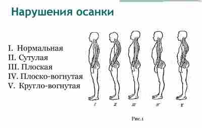 Осанка и её нарушения Под осанкой следует понимать привычную позу непринужденно стоящего человека, которую…