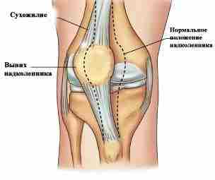 ВЫВИХ НАДКОЛЕННИКА Коленная чашечка или, как ее иначе принято именовать, надколенник, представляет собой сесамовидную…