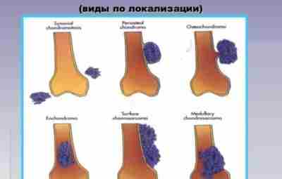 Энхондрома бедренной кости. Энхондрома — разновидность доброкачественной опухоли, развивающаяся из хрящевой ткани и прорастающая…