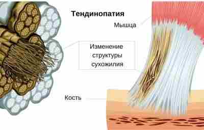 9 фактов о тендинопатиях Тендинопатия не проходит с отдыхом – боль может утихнуть, но…