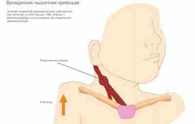 МАССАЖ И ЛЕЧЕБНАЯ ГИМНАСТИКА ПРИ ВРОЖДЕННОЙ МЫШЕЧНОЙ КРИВОШЕЕ С самого начала лечения врожденной мышечной…