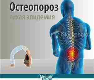 Яблучанский Н.И., Лысенко Н.В. Остеопороз. В помощь практическому врачу В книге подробно изложены сведения…