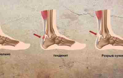 Два простых упражнения для укрепления стоп, голеностопов и ахилла Мы знаем, что ахиллово сухожилие…