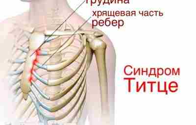 Синдром Титце https://m.vk.com/@med_sport-sindrom-titce Article