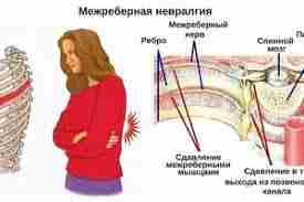 МЕЖРЕБЕРНАЯ НЕВРАЛГИЯ: СИМПТОМЫ, ПРИЧИНЫ, ЛЕЧЕНИЕ. МЕЖРЕБЕРНАЯ НЕВРАЛГИЯ — это патология, заключающаяся в сдавливании и…