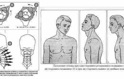 Почему возникают подвывих и вывих шейного позвонка, каковы их симптомы и лечение? Подвывих шейного…