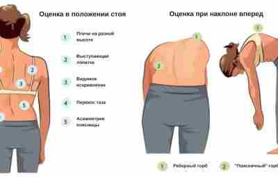 Тест Адамса (скрининг-тест на сколиоз) Когда вы смотрите на позвоночник сбоку, то видите шейный…