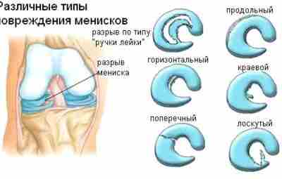 Неблокирующие разрывы мениска: операция или физическая терапия? Результаты некоторых недавно опубликованных исследований показывают, что…