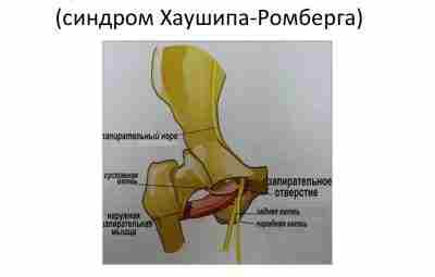 СИНДРОМ ЗАПИРАТЕЛЬНОГО НЕРВА (СИНДРОМ ХАУШИПА-РОМБЕРГА) Запирательный нерв (nervus obturatorius) образуется из передних ветвей LIΙ-LIV…