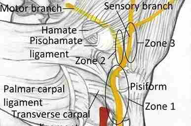 Cyclist’s Palsy (с-ом канала Гюйона) Анатомия канала Гийона Длина канала Гюйона в среднем составляет…