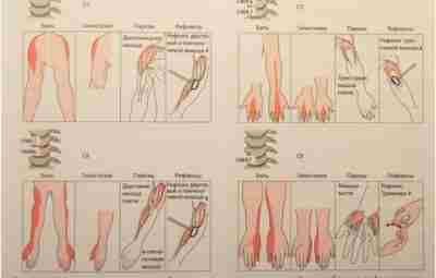 НЕВРОЛОГИЧЕСКАЯ СИМПТОМАТИКА ПРИ КОМПРЕССИОННОМ СИНДРОМЕ НА ШЕЙНОМ УРОВНЕ