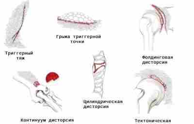 Типы фасциальных нарушений (согласно, FDM терапии): 1) Триггерный тяж Наиболее часто встречающаяся патология, заключающаяся…